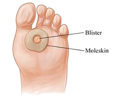 Illustration for article titled Foot
Blisters: One Of The Most Exasperating Injuries